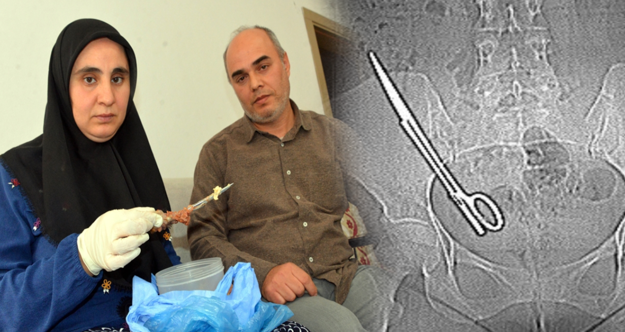 Karnında unutulan makas, 7 yıl sonra bu türlü çıktı
