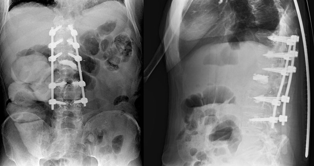 Ağrı şikayetiyle hastaneye geldi, 8,5 kilogramlık tümörlü böbrek çıktı