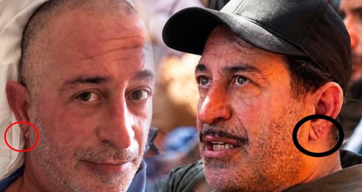 Kulak memesindeki çizgi (frank çizgisi) ne anlama geliyor, gerçekten kalp krizi belirtisi mi?